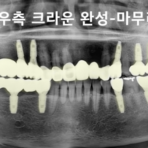 우측