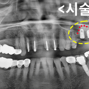 시술후